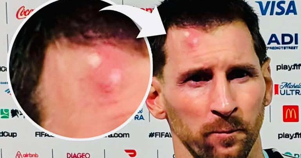 Messi sưng vêu trán sau trận thắng Cabo Verde: Vì sao nên nỗi? - hình ảnh - 789betgame.com